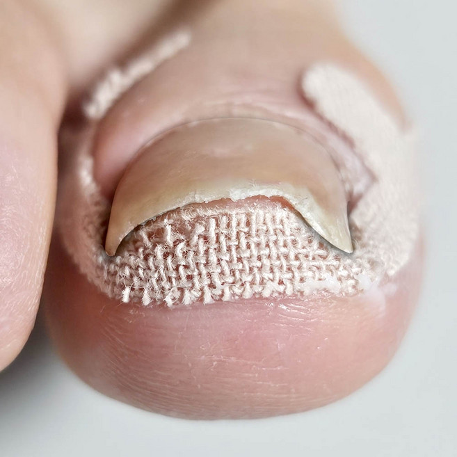 깔끔더하기 내성발톱 보호 밴드 케어 테이프, 200개