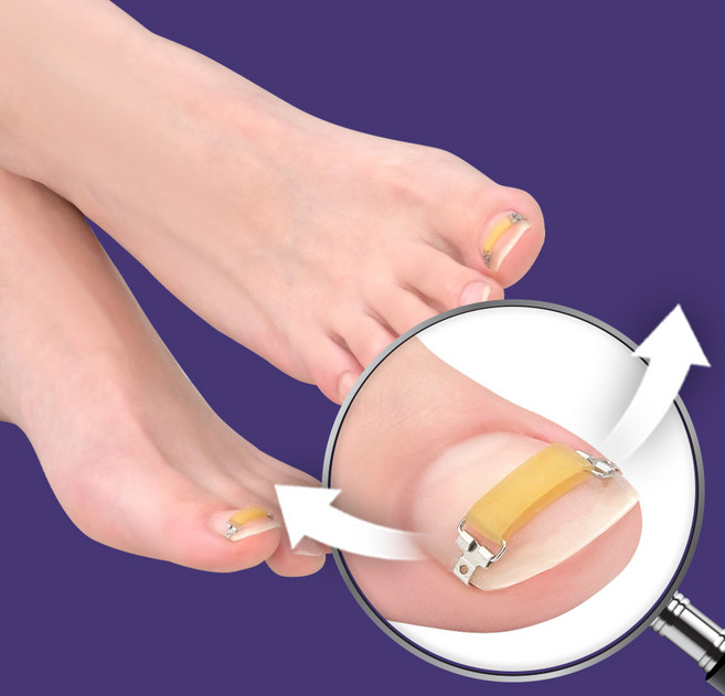 퍼펙토 내성발톱 교정기 플렉스트립 단품 파고드는 내향성 발톱 자가치료 의료기기, 3개