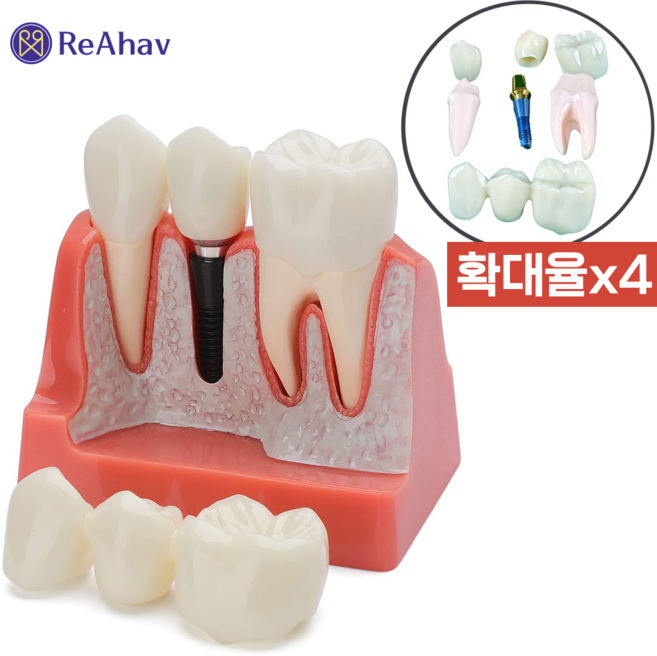 레아하브 덴티프로 4배 치아 임플란트 모델 치과 신경치료 설명 모형 병원 장식 환자 실습 교구, 1세트