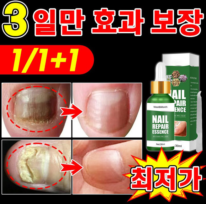 [네일케어] 발톱 거품나는앰플 솔루션 문제성발톱 앰플 발톱 곰팡이 한번에끝내는 손발톱 영양제 보장증정, 1개, 30ml