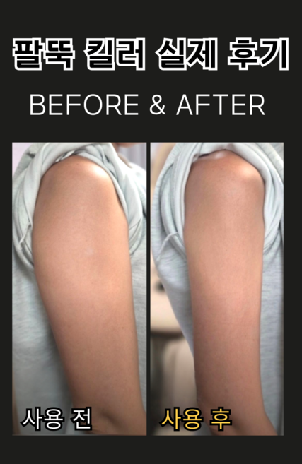 팔뚝킬러 팔뚝살빼기 팔뚝압박밴드 다이어트 겨드랑이살
