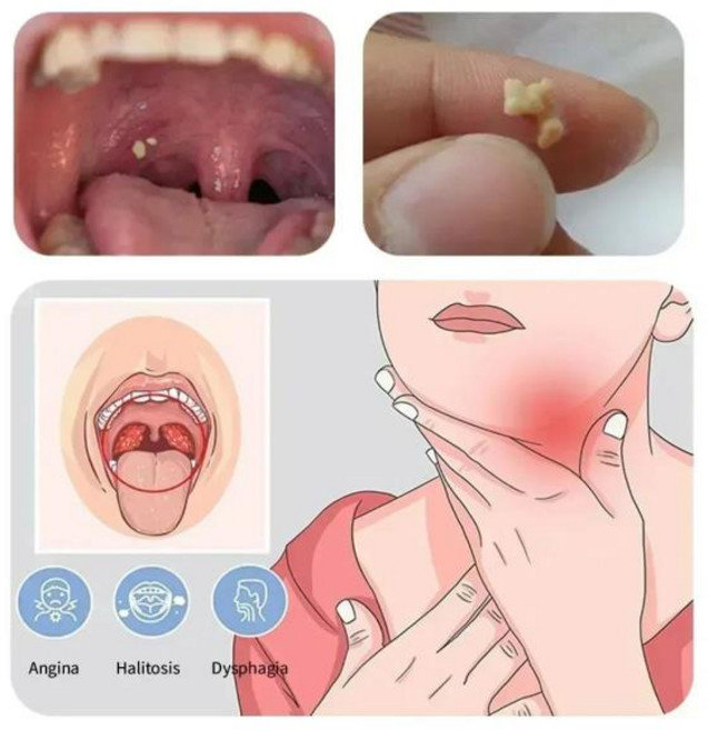 편도석 제거 도구 LED 라이트 스테인리스 스틸 제거기 구강 청소 관리 도구