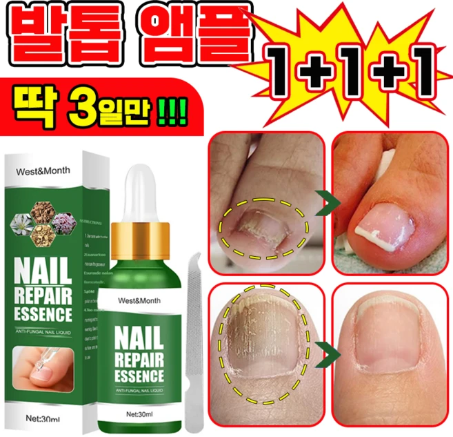 [국내배송] 발톱 거품나는앰플 솔루션 문제성발톱 앰플 발톱 곰팡이 한번에끝내는 손발톱 영양제 보장증정, 3개, 30ml - 쿠팡