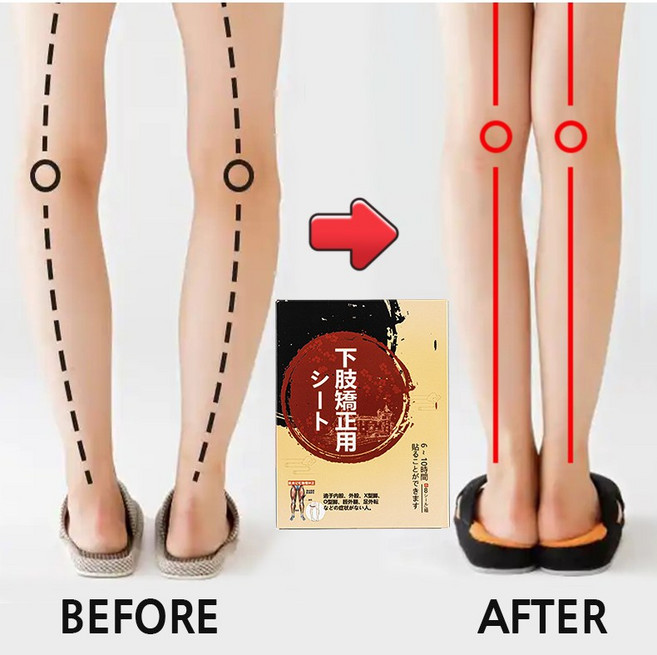 오다리교정 패치 안짱다리교정 패치 팔자걸음교정 패치 휜다리교정 패치 x자다리교정 패치, 8개입, 2개