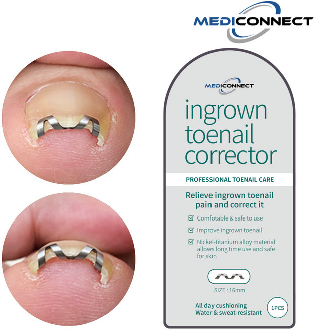 메디커넥트 내성발톱 교정기 내향성발톱 치료 파고드는발톱 교정, 1개