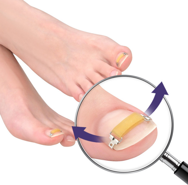 퍼펙토 내성발톱 교정기 플렉스트립 단품 파고드는 내향성 발톱 자가치료 의료기기, 3개