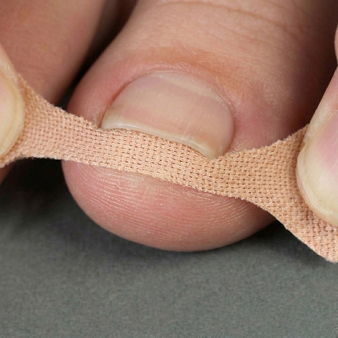 홈베리카 셀프케어 발톱 교정 내성발톱 테이프, 1세트