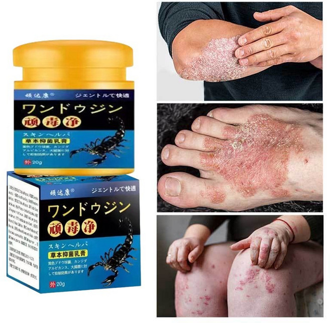 항균소염크림 건선/습진/붉은피부/모기물림/ 두드러기/피부염/두피선/피부소양증, 1개, GH12