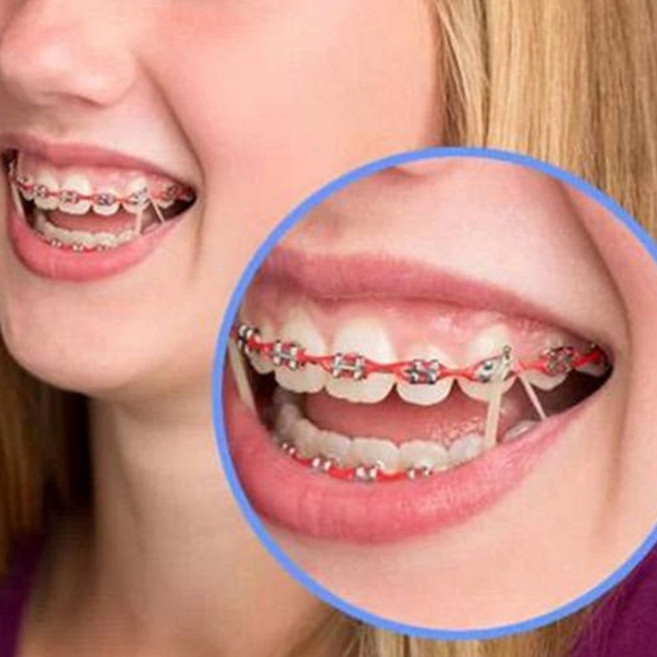 교정기고무줄 치아교정고무줄 이빨셀프교정 100개, 1개