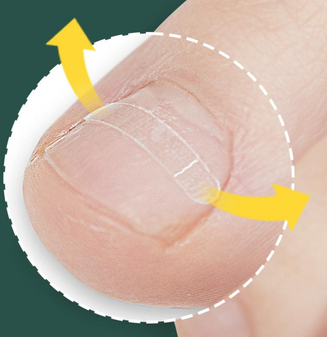 10매+10매 퍼펙토 내성발톱 교정기 스트립 교정팁 의료기기 자가치료 세트, 10개