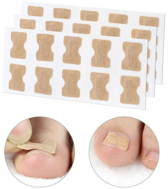 지니홀딩스 휘는발톱 밴드 50P 내성발톱 파고드는 발톱 내향성 변형 발톱밴드, 1세트