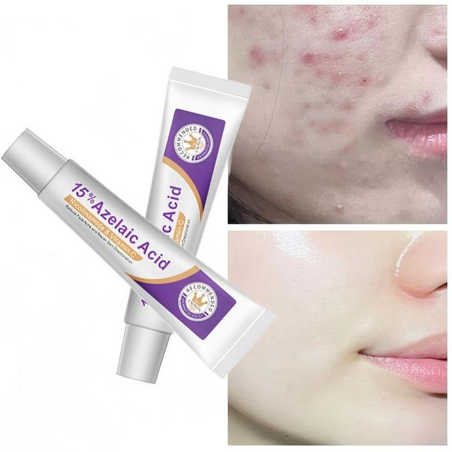 아-젤라-산 15% 고함량 모공 각질 케어 모공 관리 피부 진정, 2개, 20g