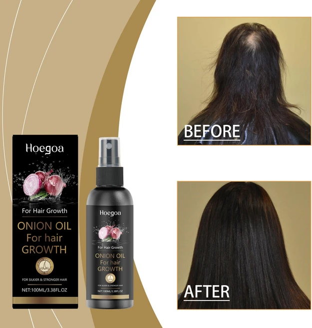 Hoegoa 양파 오일 헤어 스프레이 어니언오일 헤어 강화 모발 영양 보습, 1개, 100ml - 쿠팡