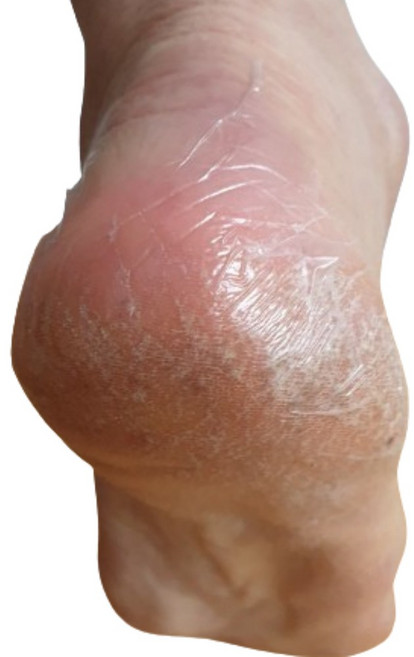 30매 발각질제거패치 발뒷꿈치갈라짐 굳은살 각질완화, 1개, 30매입