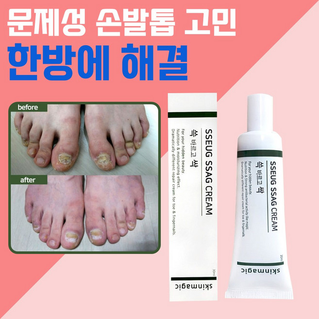 문제성 손발톱 케어 뒤꿈치 갈라짐 두꺼운 발톱 손톱 발각질 뒤꿈치 각질 제거 연화제 풋케어 올인원 치유크림 쓱싹크림 30ml 쓱싹크린풋 발비누 별도 구매 가능, 쓱싹크림 + 쓱싹크린풋 발비누, 1개, 1개입