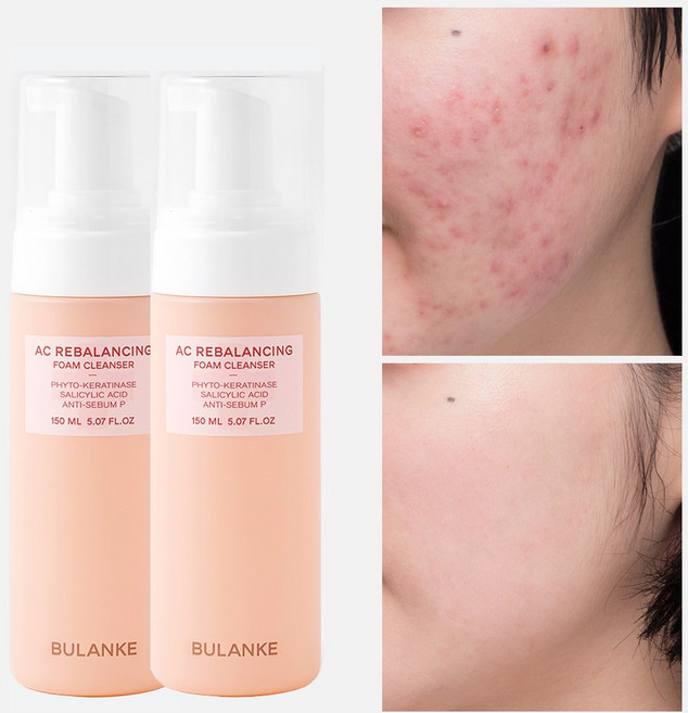 불란케 에이씨 리밸런싱 여드름 기능성 청소년 약산성 폼클렌징, 2개, 150ml