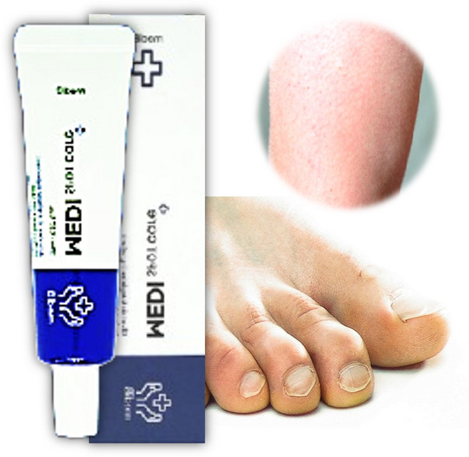 굳은살연고 발바닥 각화형 무좀 굳은살제거 연고 피부 연화제 풋크림, 20ml, 1개