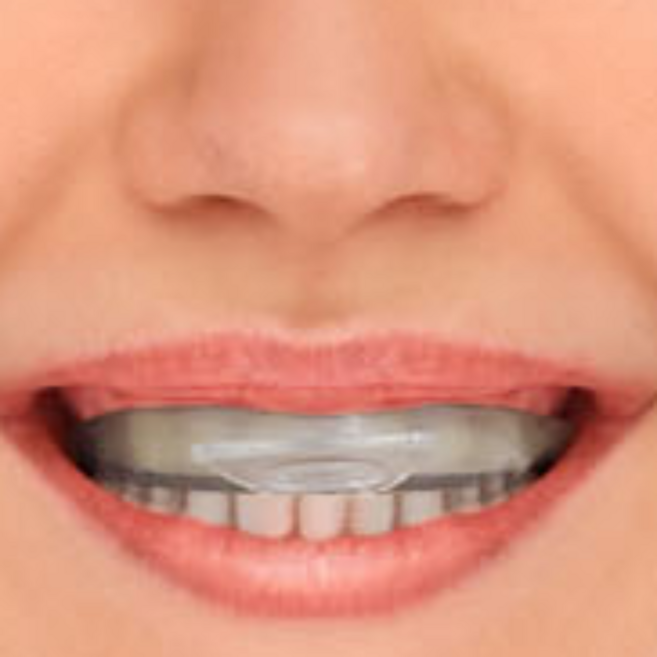 이빨갈기교정 이악물고자는 이꽉무는습관 이악무는습관교정 이꽉무는습관교정, 투명