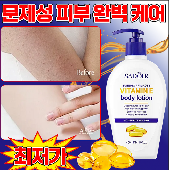 [즉각보습] 고보습 바디로션 모공각화증 바디로션 문제성피부 여성 남자 바디크림, 1개, 400ml