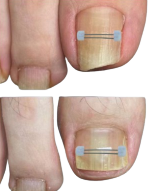 신짱 컴퍼니 파고드는 내성발톱 와이어 팁(10p), 10개