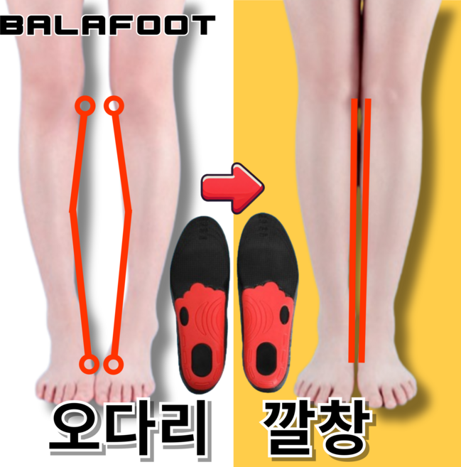 발아풋 오다리 깔창 팔자걸음 휜다리, 1개