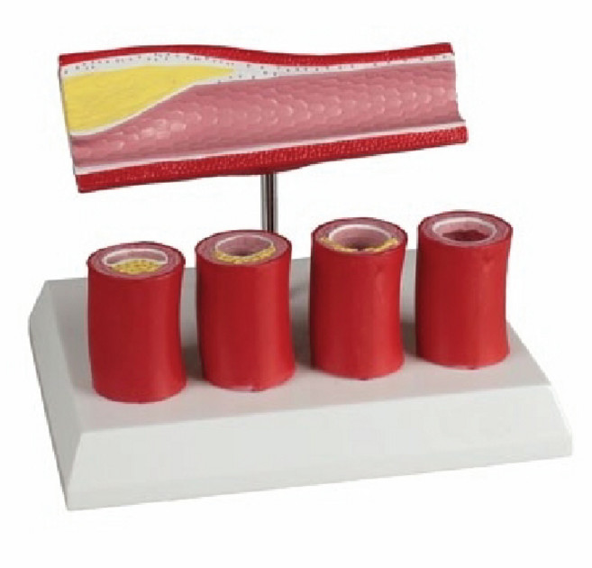 동맥 내 플라크모형 G240 혈관모형 동맥플라크 동맥경화 혈관지방 콜레스테롤 보건교육 과학실 학교 병원 교육용 인체모형, 단품