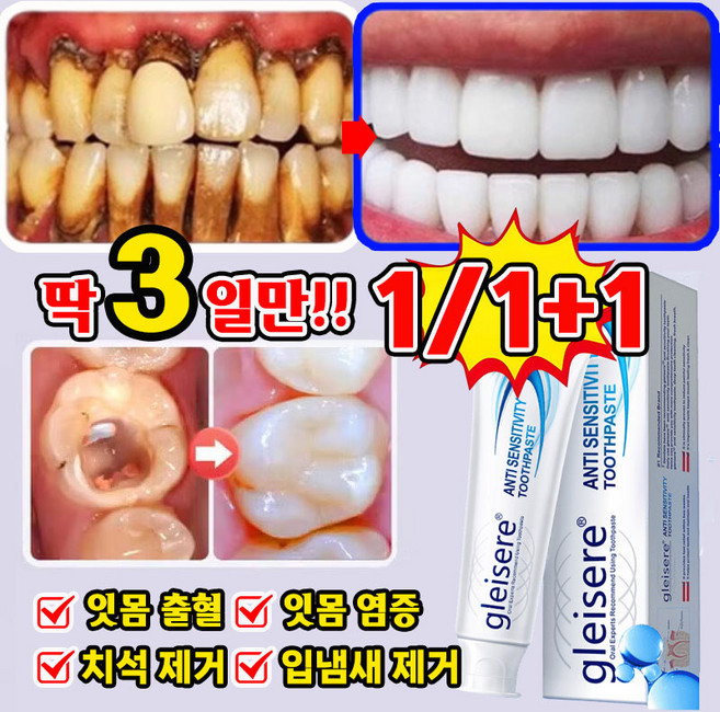 [예방 및 관리 효과!!!] 잇몸 재생 치약 치아 미백 치약 치주염 잇몸 붓기 염증 입냄새 치석제거 구취케어 약구전용 포장 랜덤 증정, 2개, 100g