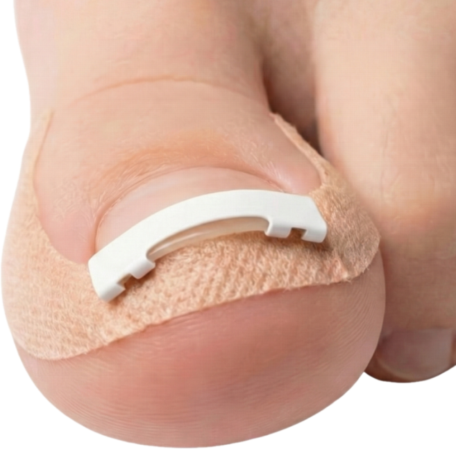 라이언문 니티놀 내성발톱 교정기, 1세트