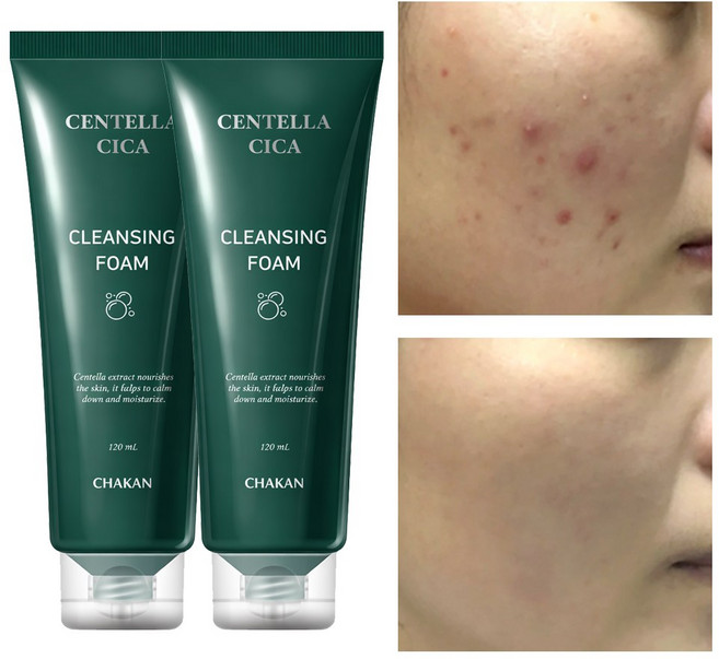 여드름 기능성 클렌징폼 좁쌀 아크네 사춘기 청소년 화장품 수부지 센텔라 시카 클렌저, 2개여드름모공피지각질제거센텔라시카폼클렌징, 120ml, 2개