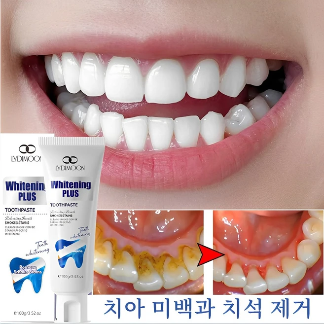 미백 치약 Whitening Toothpaste 프로바이오틱스 치약 치태 치약 치태 제거 프로바이오틱스 미백 치약 프로바이오틱스 치태 치약 구취 제거, 1개, 100g - 쿠팡