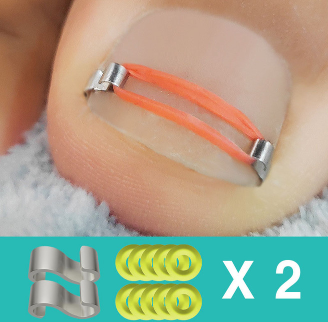 루리온 엄지발톱 보정기, 1개