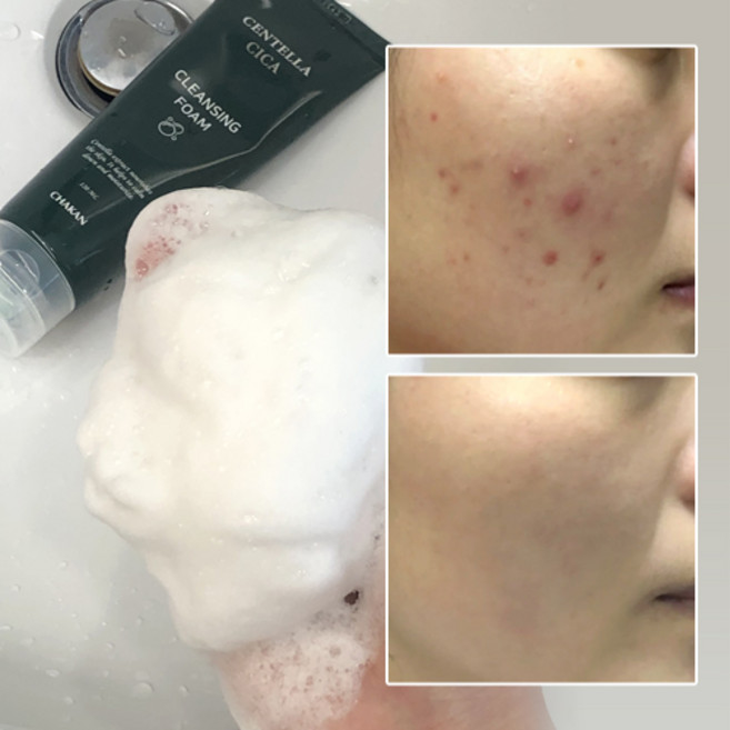 여드름 기능성 클렌징폼 좁쌀 아크네 사춘기 청소년 화장품 수부지 센텔라 시카 클렌저, 1개여드름모공피지각질제거센텔라시카폼클렌징, 120ml, 1개
