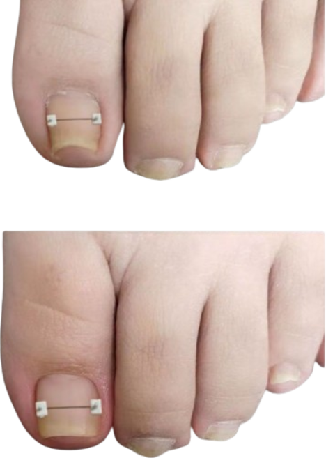 신짱컴퍼니 내맘대로길이 조절 내성발톱 셀프 교정기, 1세트