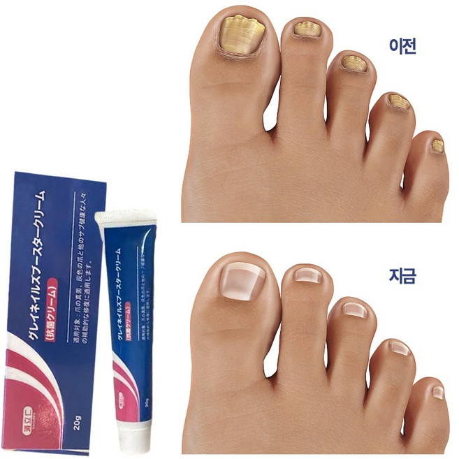 [국내배송] 솔루션 문제성발톱 앰플 발톱 곰팡이 한번에끝내는 손발톱 영양제 발톱 곰팡이 치료제, 20g, 1개, 1개입