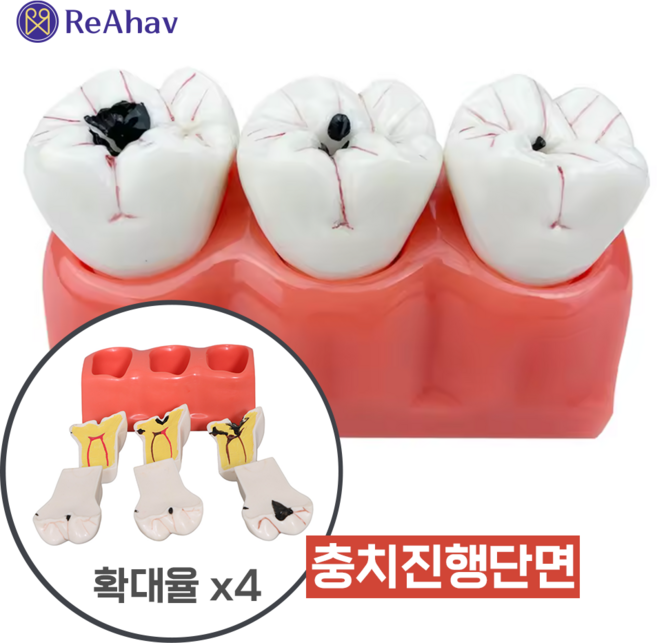 레아하브 충치가이드 4배 치아 충치 진행 모델 단계별 설명 모형 치과 신경치료 실습 교구 병원 장식 환자, 1세트