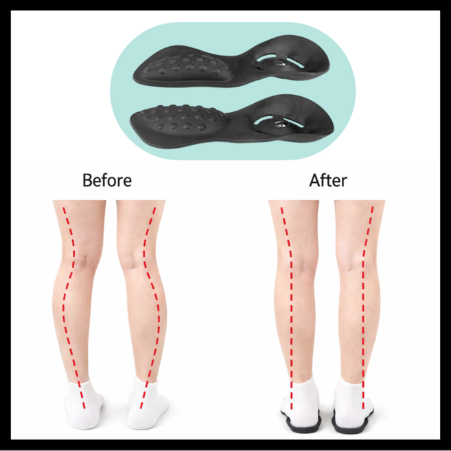 3초깔창 오다리 휜다리 x자다리 교정 신발 깔창, 1세트