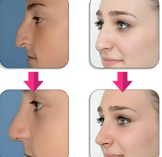 코볼축소 매부리코교정 복코교정 코뼈교정 휜코교정 휜코교정기, 2개, 찐핑크