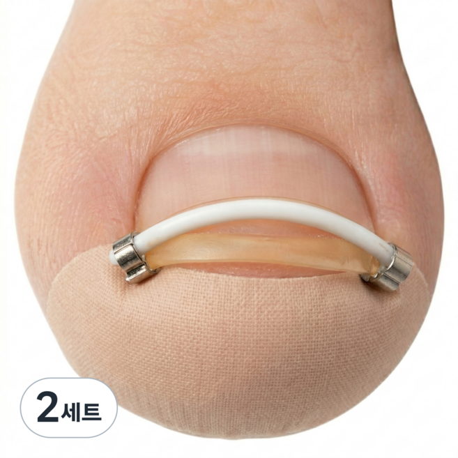 라이언문 NiTi 와이어 내성발톱 교정기, 2세트