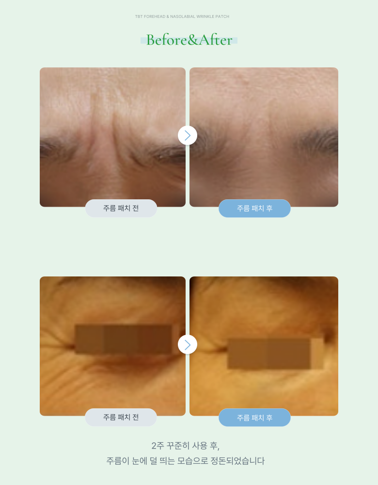 Tibiti 5 Set Dae Migan Nun Anti-Wrinkle Tumyeong Paechi Seutikeo , 2 Pack , 27 Pack (티비티 5세대 미간 눈가 주름 투명 패치 스티커, 2개, 27개입)