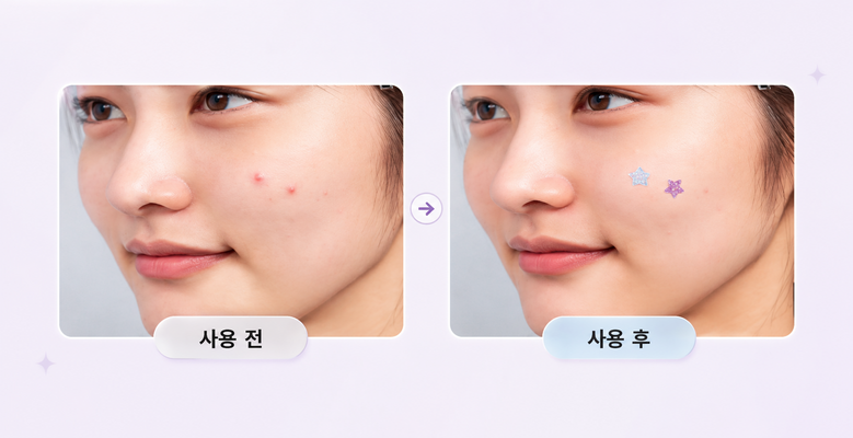 Tibiti Byeol Banjjak Moyang Acne Keobeo Spot Paechi , 1 Pack , 200 Pack (티비티 별 반짝이 모양 여드름 커버 스팟 패치, 1개, 200개입)