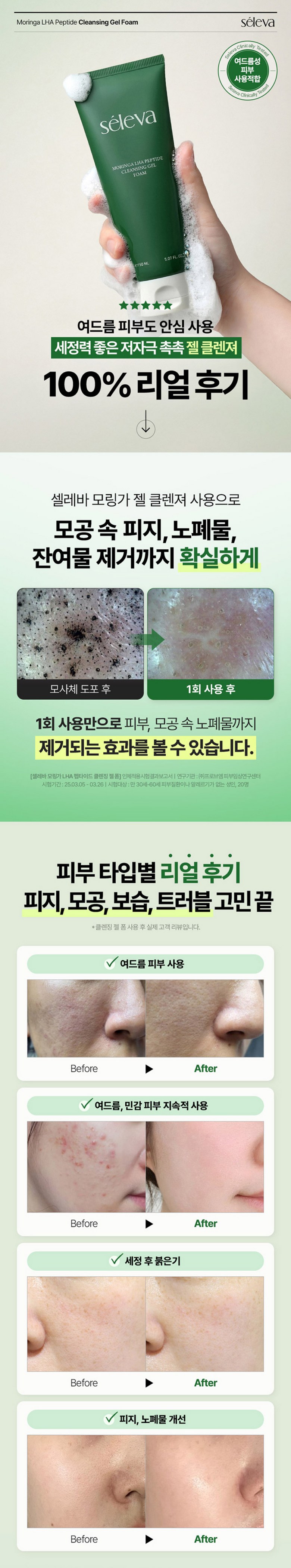 Selreba Mujageuk Acne Cleansing Gel Sebum Jungjeung +7 Ji Pack Seon Imsang Hwakin Skin Sensitive Skin Moisture Low Irritation Moring Foam Cleanser , 1 Pack , 150 ml (셀레바 무자극 여드름 클렌징젤 피지 중증도+7가지 개선 임상 확인 피부과 민감 피부 수분 저자극 모링가 폼클렌징, 1개, 150ml)