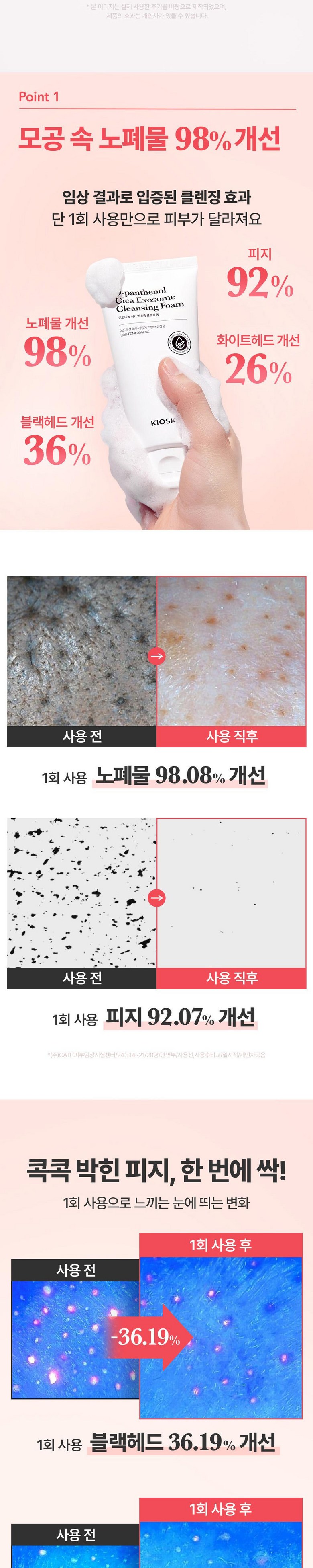 Sebum 92% Pack Seon Acne Wanhwa Cleansing Foam Pore Set Jeong Sikaeksojom Soothing Moisturizing Yakalkalri Low Irritation Blackhead Sebum Jegeo Nonkomejenik , 1 Pack , 120 (피지 92%개선 여드름완화 클렌징폼 모공세정 시카엑소좀 진정보습 약알칼리 저자극 블랙헤드 피지제거 논코메도제닉, 1개, 120ml)