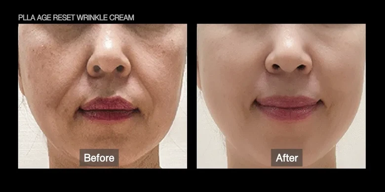 Paljapilreo Cream | Seul Selrateu PLLA Ji Riset Ringkeul Cream Peulreoseu , 1 Pack , 1 Pack (팔자필러크림 | 에슬 에셀라이트 PLLA 에이지 리셋 링클 크림 플러스, 1개, 1개입)